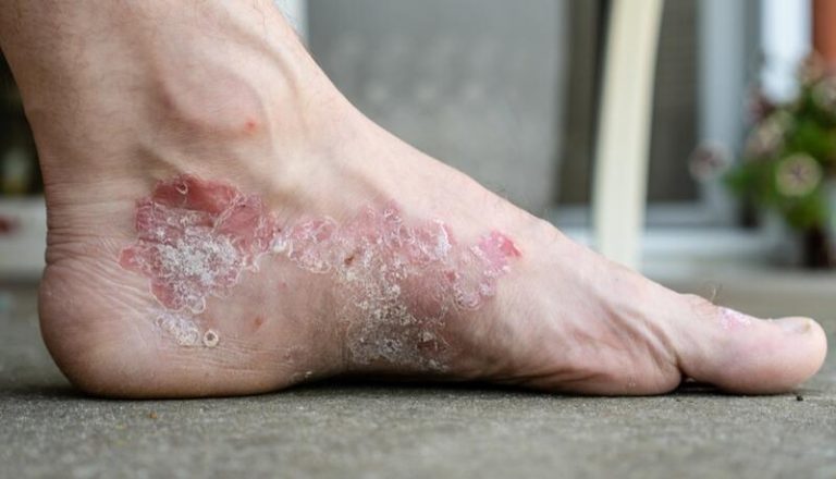 Descubren un nuevo tipo de célula en la piel que contribuye a enfermedades como la psoriaris