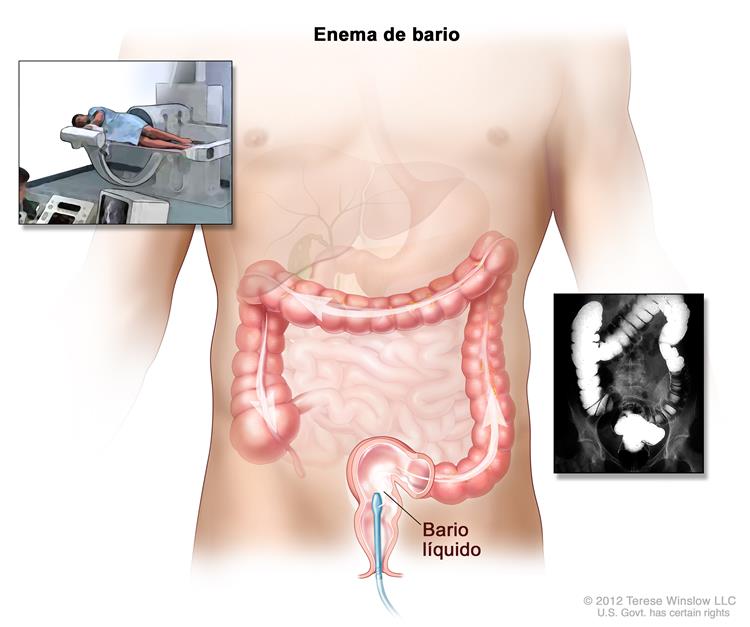 El Agua Oxigenada Sirve Para Los Enemas