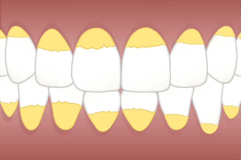 ¿Qué Es Un Curetaje Dental?