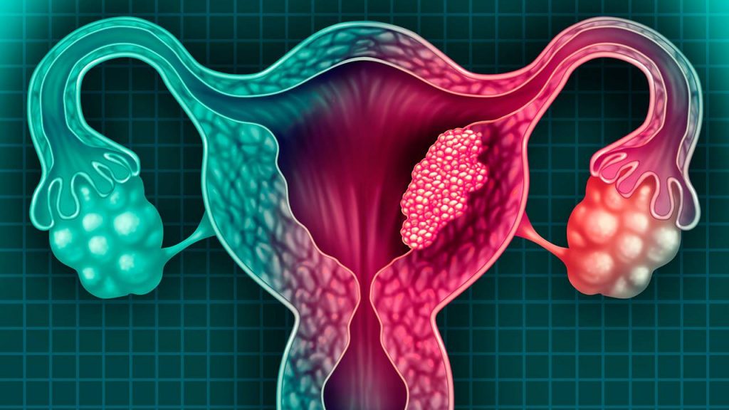 ¿Qué Es El Cáncer De Cérvix?