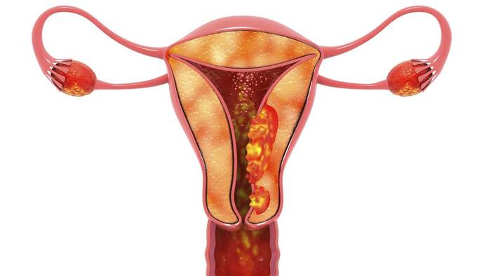 ¿Cuáles son las etapas de cáncer de cérvix?