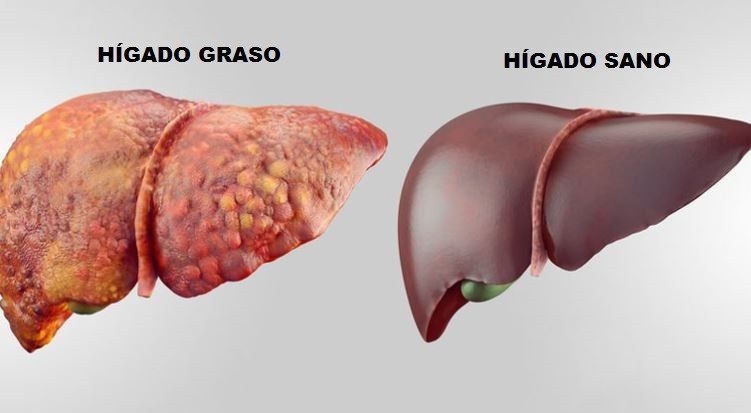 ¿Qué Es El Hígado Graso?