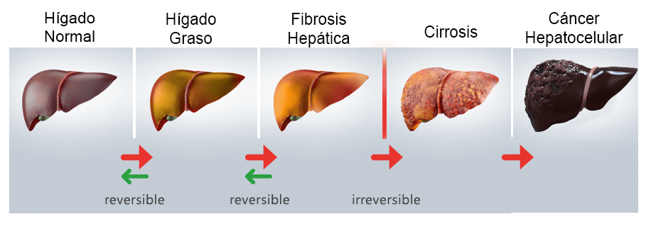 ¿Cuántos Tipos De Hígado Grasos Existen?