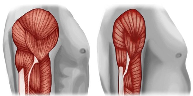 Qué Es La Atrofia Muscular 4 ¿Qué Es La Sarcopenia?