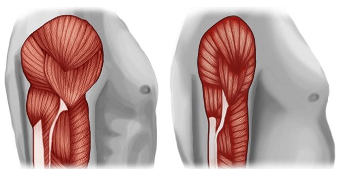 ¿Qué Es La Sarcopenia?