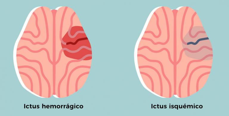 ¿Se Puede Detectar Un Ictus?