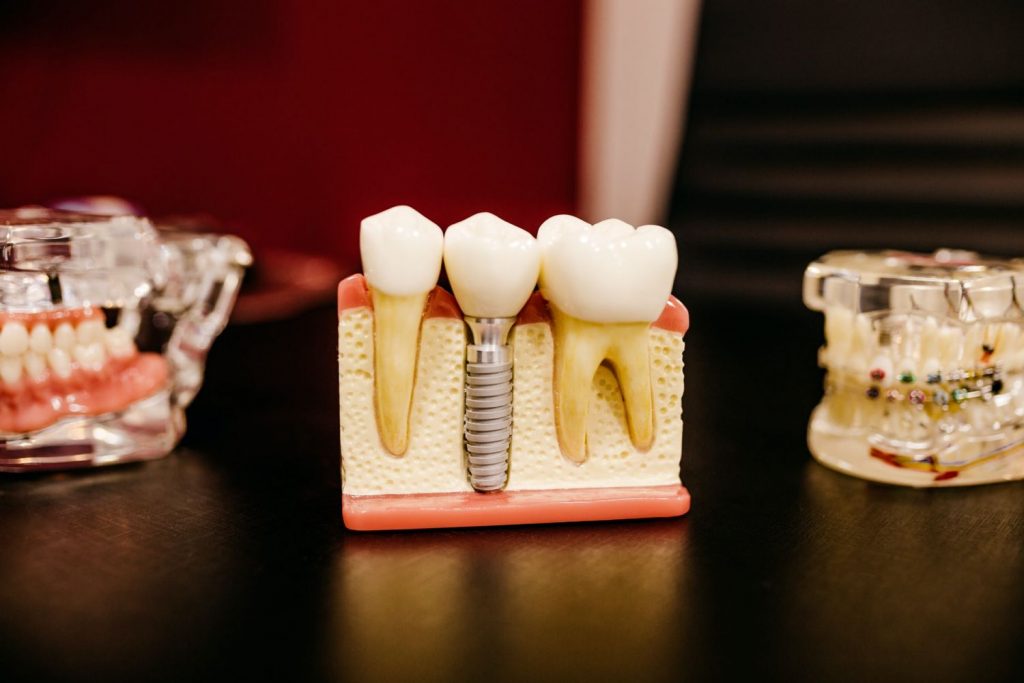 ¿Por Qué La Pulpa Dental Se Inflama?