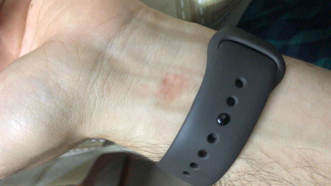 Qué hacer si Apple Watch te ha quemado o provocado reacciones en tu piel