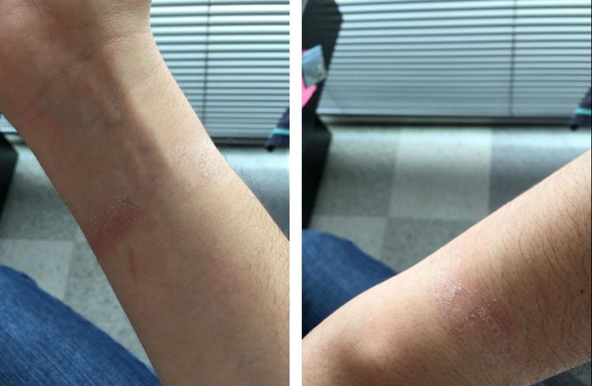 Qué hacer si Apple Watch te ha quemado o provocado reacciones en tu piel