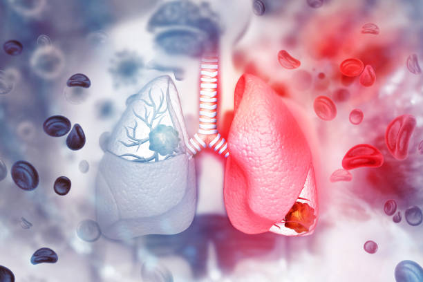 Cómo detectar de forma rápida si sufres cáncer de pulmón