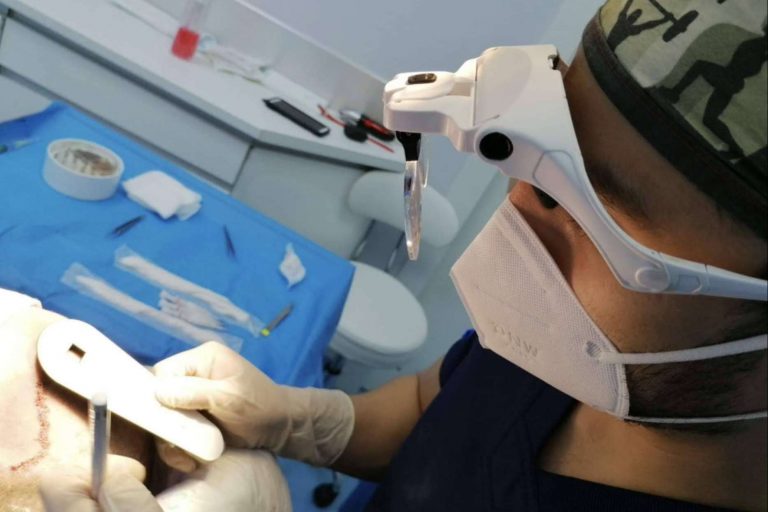 ¿Cuándo se cae el pelo implantado?, por Doctor Bern