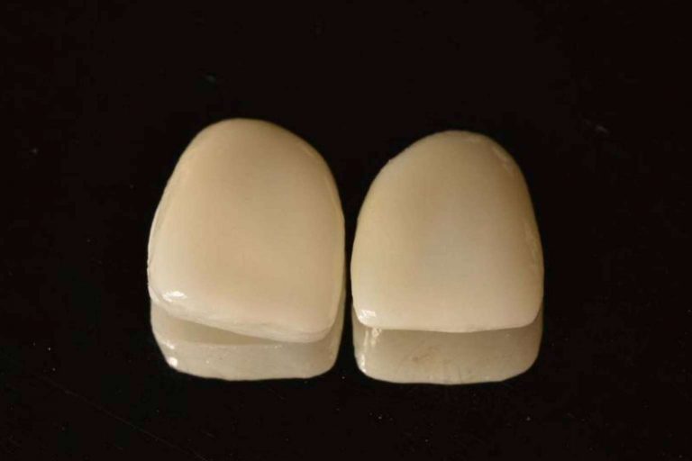 Sonrisa perfecta con tratamientos 0 invasivos gracias a las carillas Emax y las inyectadas de composite de Implant Clinics