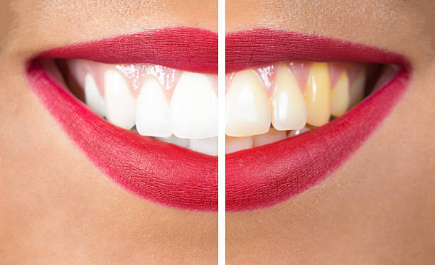 Como Blanquear Unos Dientes Amarillos 1 ¿Qué Debo Hacer Para Blanquear Los Dientes?