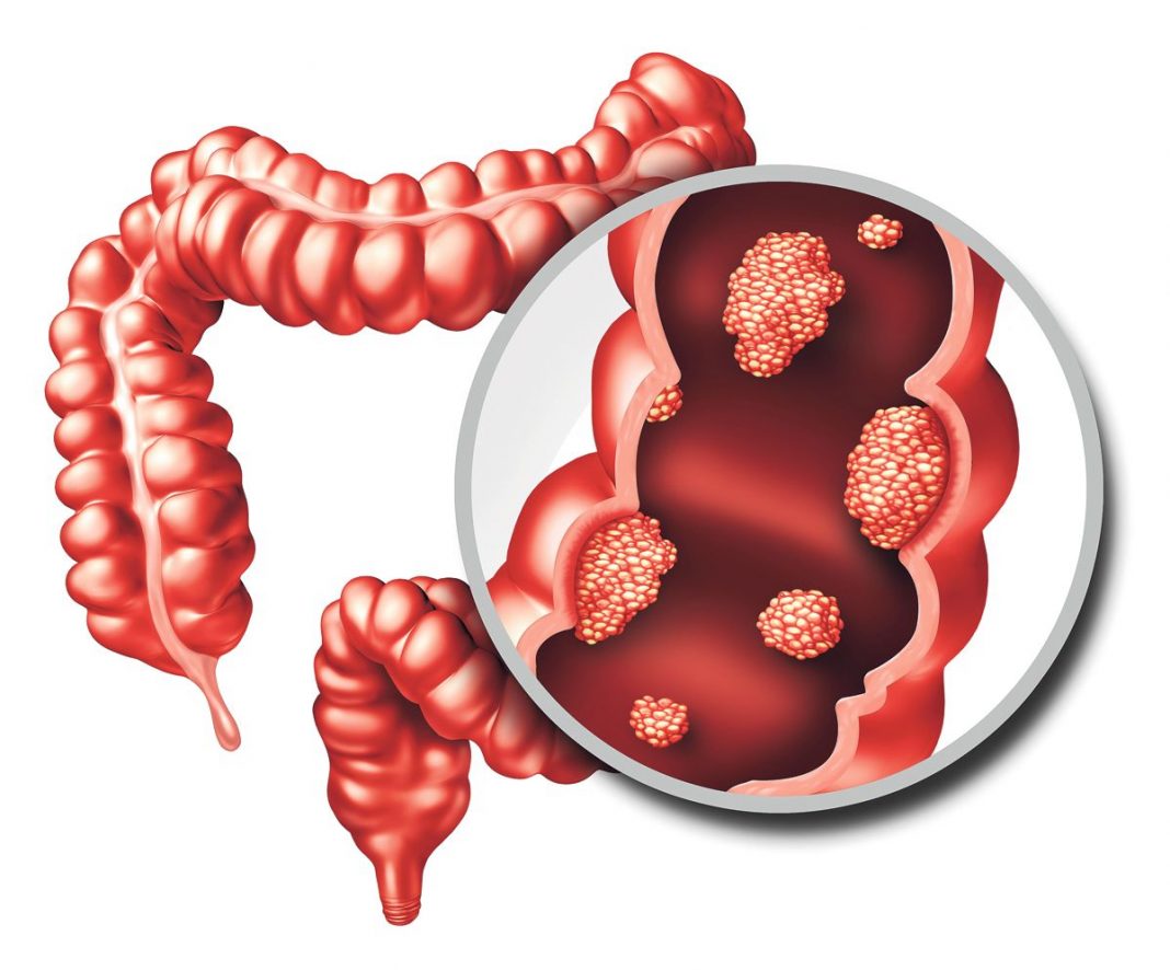 Cáncer de colon: las formas de prevenirlo