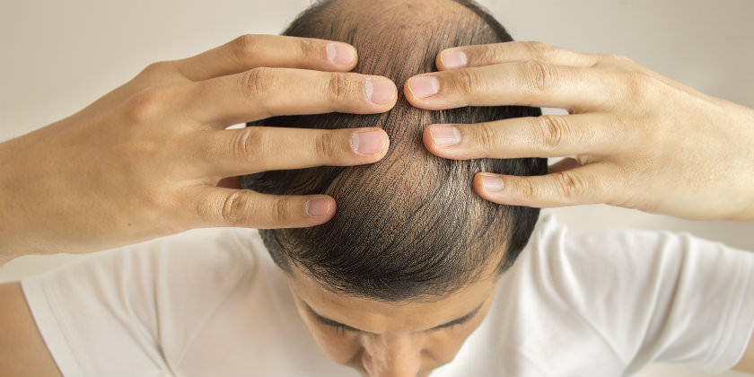 El curioso método para acabar con la caída del pelo