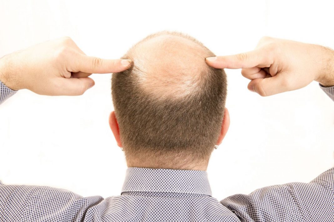 El curioso método para acabar con la caída del pelo
