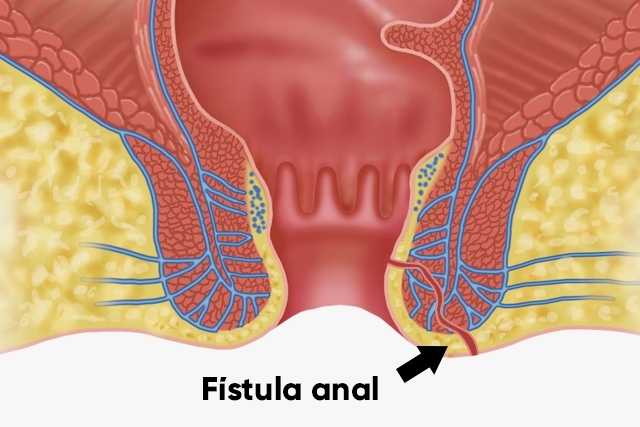 ¿Cuál Es El Tratamiento Para La Fístula?