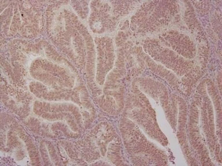 La OMS y líderes mundiales piden avanzar en la eliminación del cáncer de cuello uterino