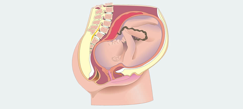 ¿Se Puede Prevenir El Desprendimiento De Placenta?