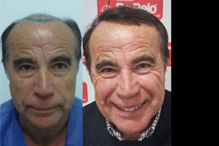 Clínicas Dr. Pelo, la importancia de conseguir trasplantes capilares con efecto natural