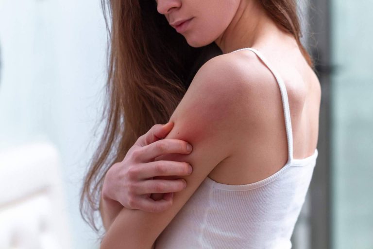 Laboratorio Géomer lanza un tratamiento natural psoriasis corporal sin cortisona