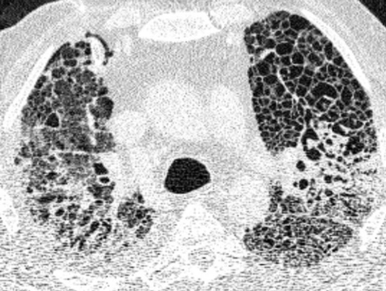 La mayoría de pacientes con COVID-19 grave desarrollan cicatrización pulmonar pronunciada
