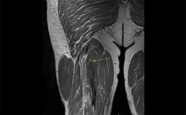 Un estudio observa que los músculos crecen en pacientes covid críticamente enfermos