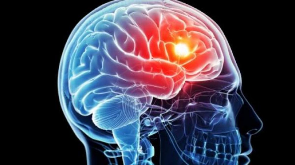 ¿Cuáles Son Los Tipos De Ictus?