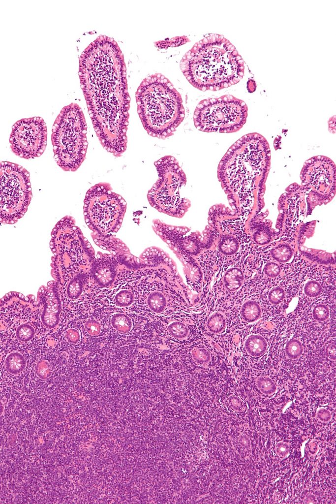 ¿La Presencia De Un Bocio Puede Originar Un Bulto En El Cuello?