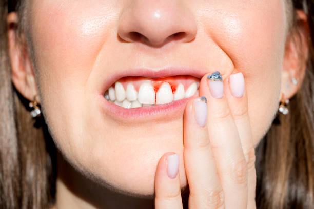 Gingivitis