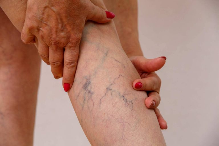 Decir adiós a las arañas y varices gracias al tratamiento con láser de la Doctora Sánchez-Peral