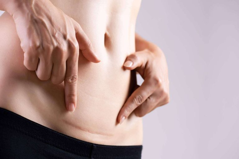 Optar por la fisioterapia y la osteopatía en el tratamiento de cicatrices y liberación de adherencias