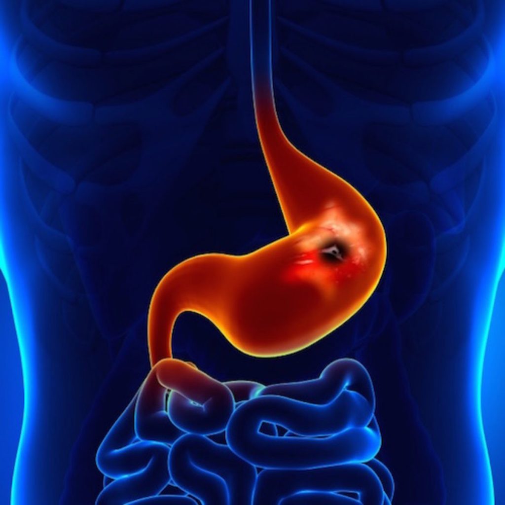 ¿Qué Causa El Dolor De Estómago Después De Comer?