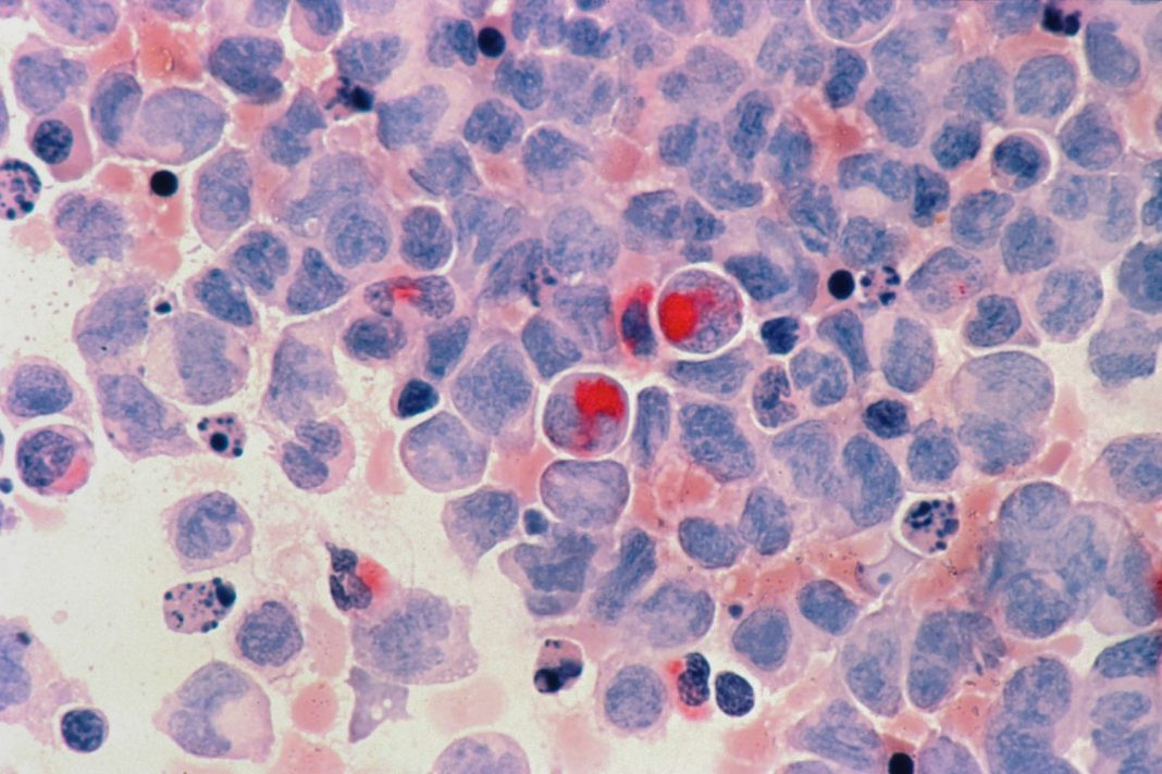 Cáncer de pulmón: síntomas que avisan de un problema