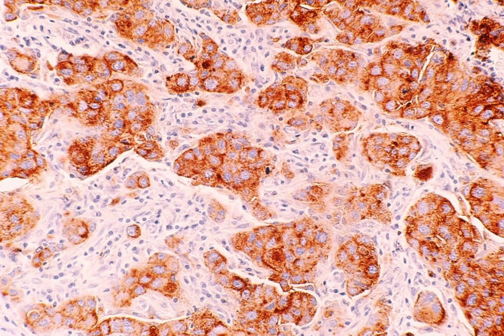 Cáncer De Pulmón: Síntomas Que Avisan De Un Problema