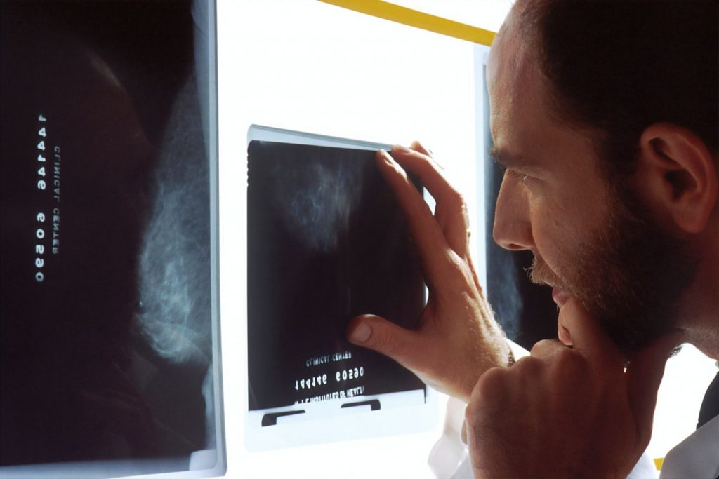 Cáncer De Pulmón: Síntomas Que Avisan De Un Problema