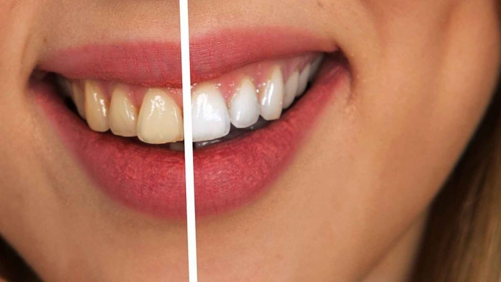 Cómo Deshacerte De Los Dientes Amarillos De Un Plumazo