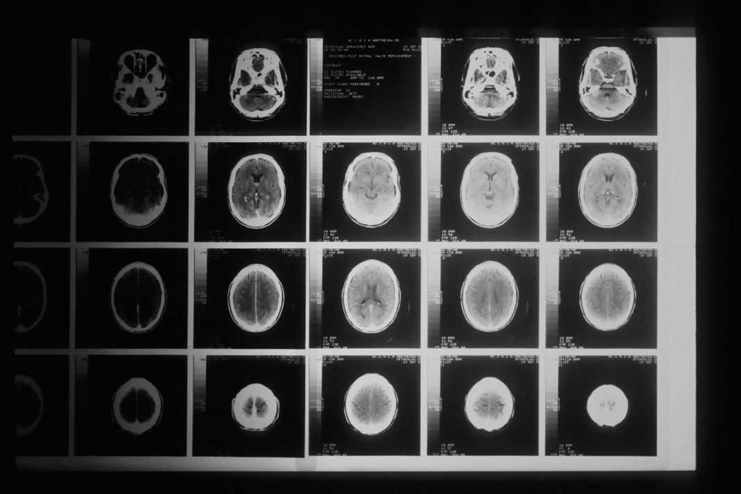 Síntomas de un ictus así te avisa tu cuerpo para que vayas a urgencias