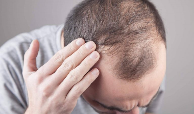 Élite Capilar ayuda a tratar la alopecia con injertos capilares efectivos