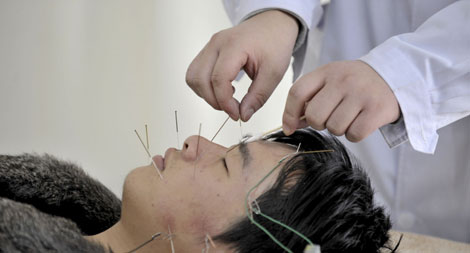¿De Qué Trata La Acupuntura?