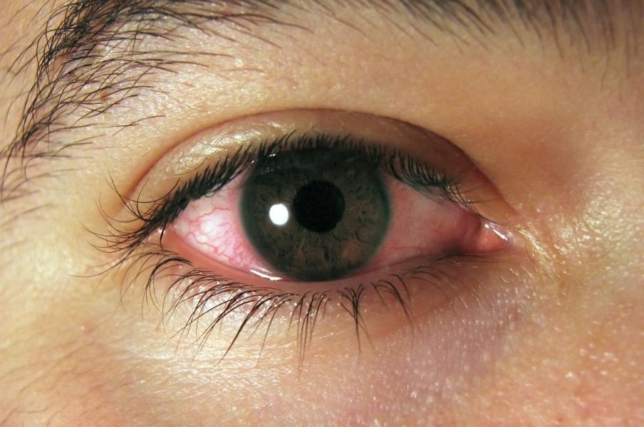 Alergias: mantener una correcta hidratación en los ojos