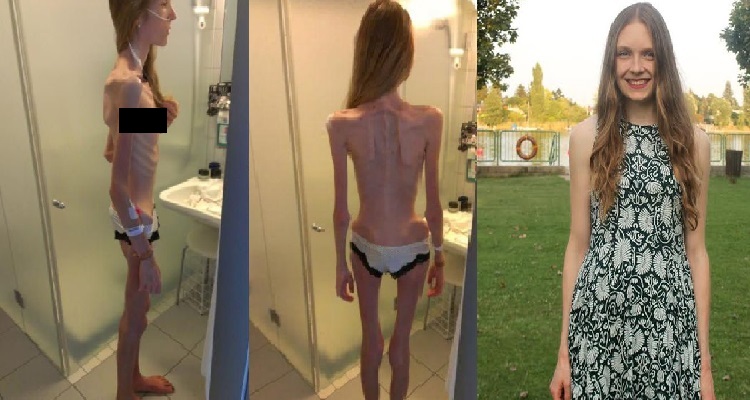 Fotos Del Antes Y Después De La Anorexia Que Sorprenden