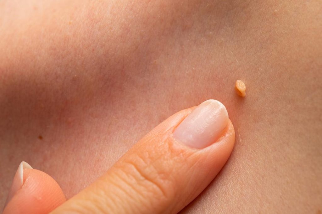 Zonas Más Comunes Donde Aparecen Verrugas
