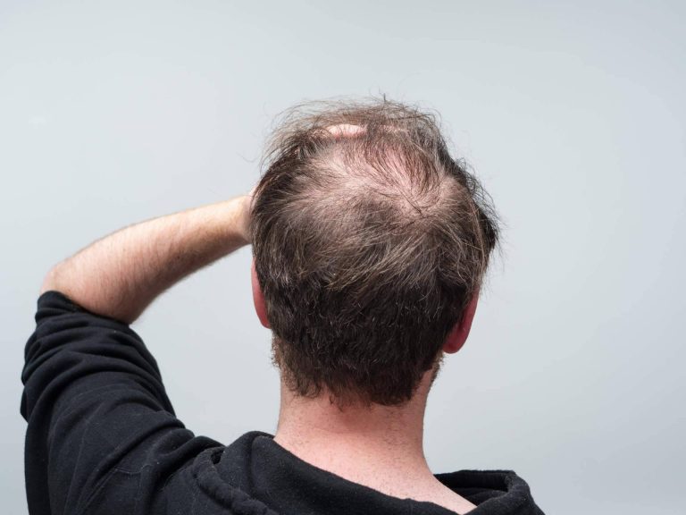 Los distintos tipos de caídas del pelo, por el Laboratorio Géomer