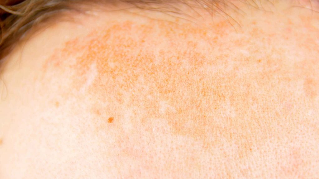 ¿qué son las manchas en la piel?