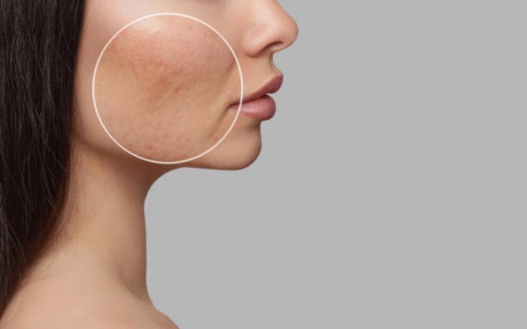 Rutina antiedad para eliminar los puntos negros de tu rostro