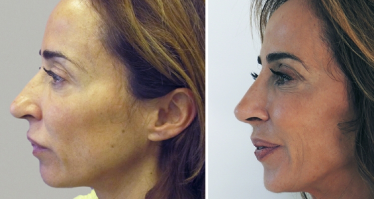 El Top De Las Mejores Rinoplastias De Famosas Españolas 49 El Top De Las Mejores Rinoplastias De Famosas Españolas