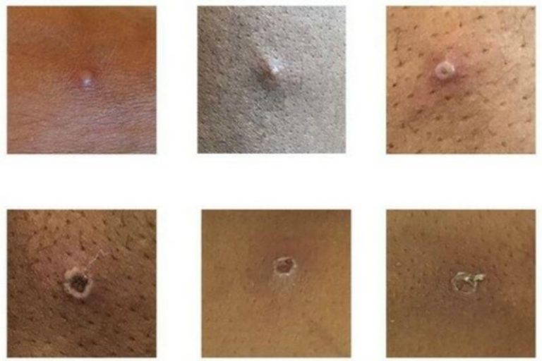 La OMS desconoce si se podrá «contener» la propagación de la viruela del mono