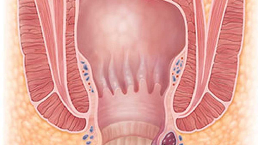 ¿Conoces Los Síntomas De Las Hemorroides?