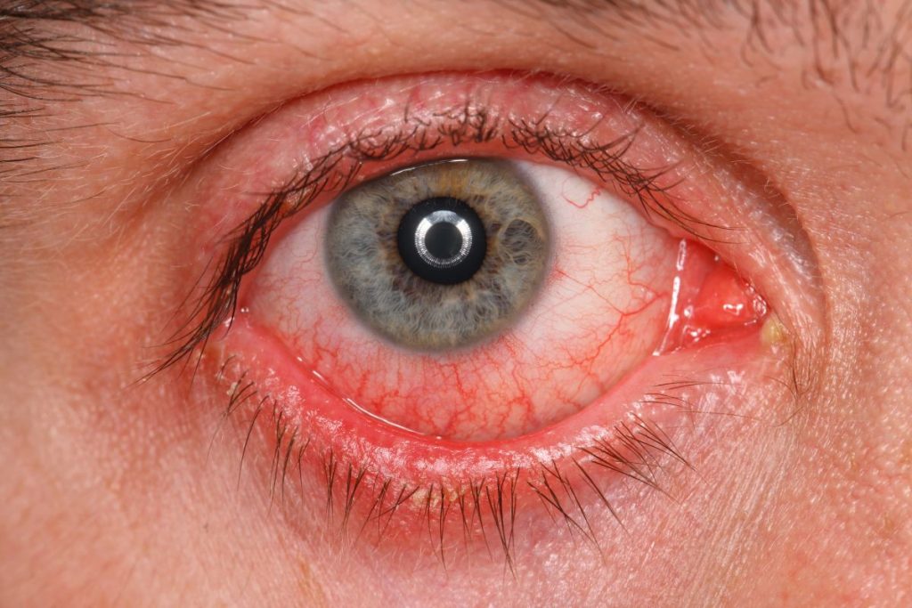 Ojo Seco